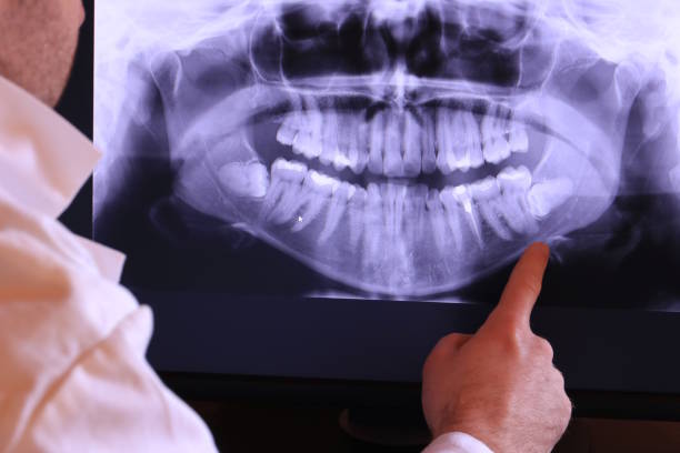 Best Emergency Dental Care for Broken or Chipped Teeth in Roanoke, IN