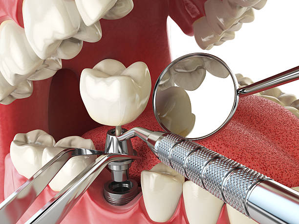 Best Emergency Gum Treatment in Roanoke, IN